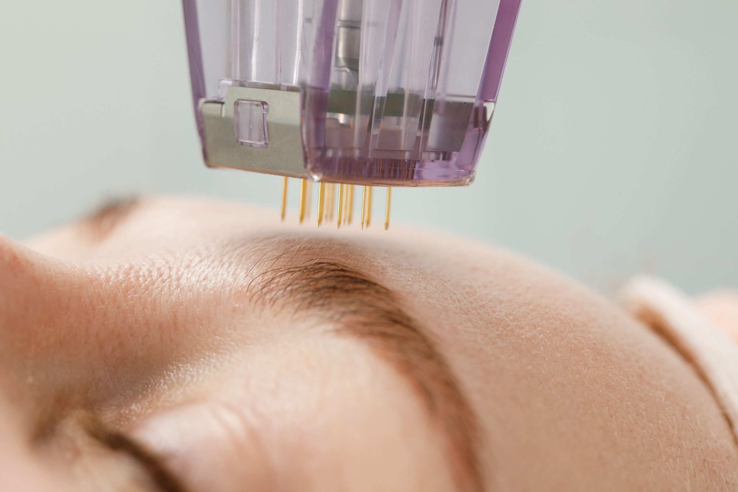 Microneedling treatment at BGY Skin Aesthetics and Spa in Jupiter, FL. Rejuvenate your skin with our advanced procedure to reduce acne scars, fine lines, and improve overall skin texture.